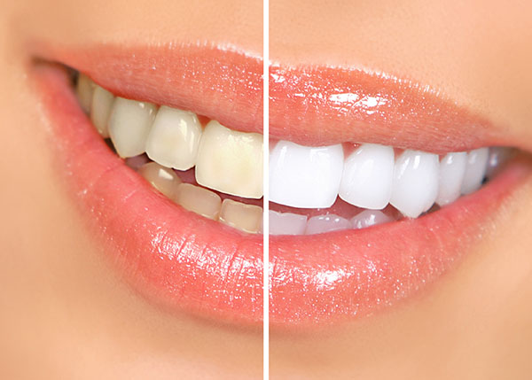 A Teeth Whitening Dentist Visit
