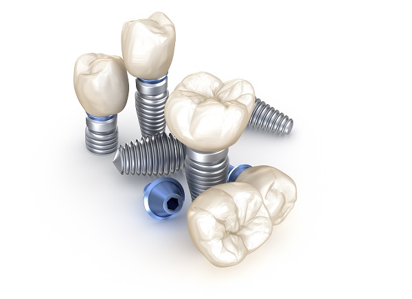 How Successful Is A Dental Implant Restoration?