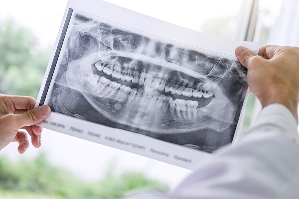 Recovering From A Dental Implant Restoration