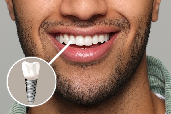 Can Dental Implants Support A Dental Bridge?