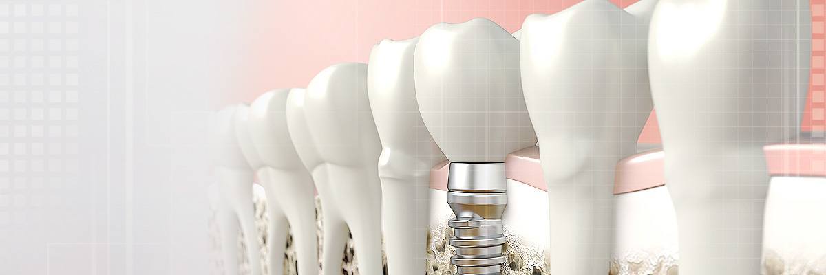 Los Angeles Dental Prosthetics