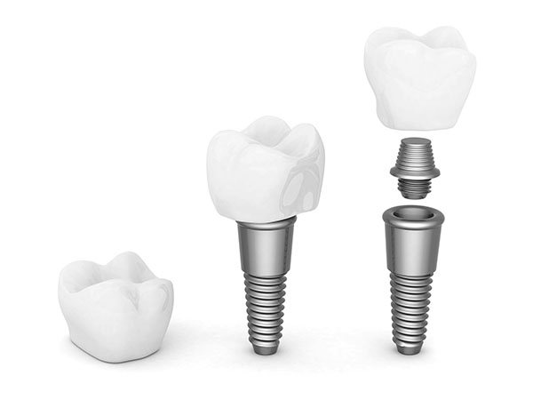 Dental Implants Are A Popular Solution For Tooth Loss
