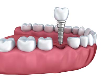 How Dental Implants Are Placed In The Jawbone