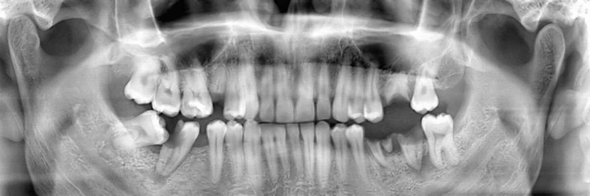 Los Angeles Wisdom Teeth Extraction